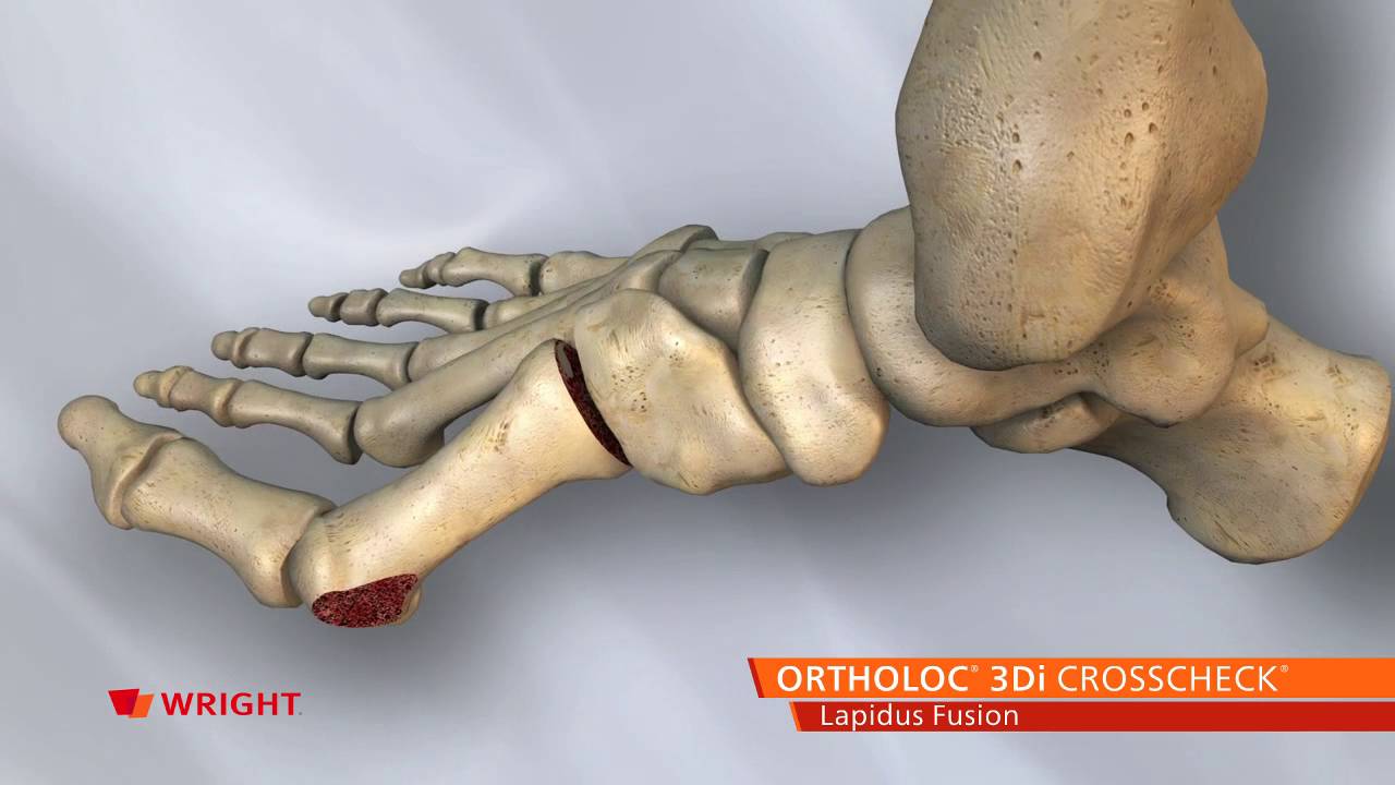 Ortholoc 3di Crosscheck Lapidus Fusion Animation Youtube