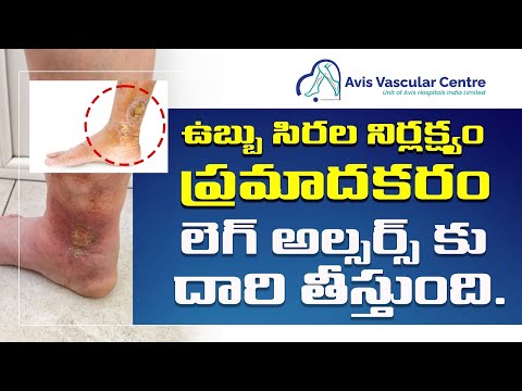 Diabetic Ulcer vs Varicose Vein Ulcer | Dr Rajah V Koppala | Avis Hospitals Jubilee Hills Hyderabad
