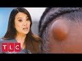 Cyst or Lipoma? Dr. Lee Cuts It Open to Find Out! | Dr. Pimple Popper: A Pimple Carol