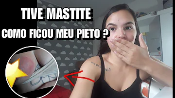 Como se faz drenagem de abscesso na mama?