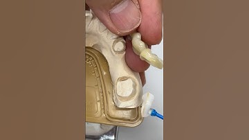 Telescopic Coping for a 3-Unit Bridge #dental #lsk121shorts #teeth #smile #shortvideo #shorts