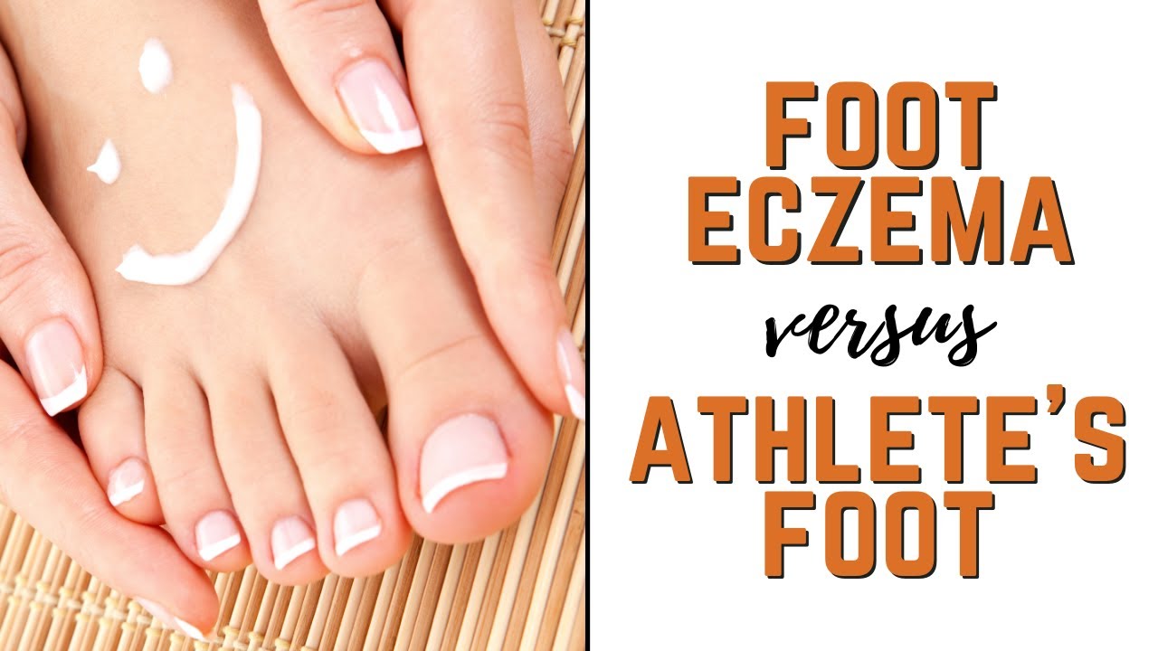 Types of Foot Eczema vs. Athlete's Feet Symptoms, Causes & Natural
