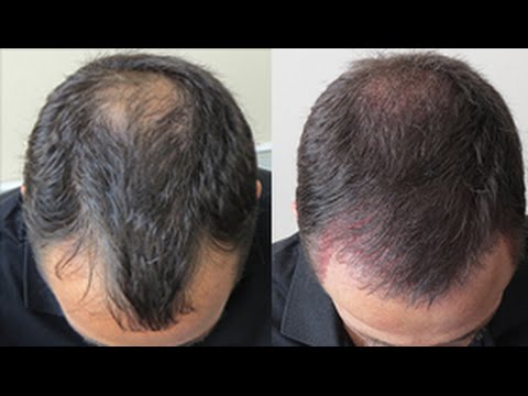 Caduta dei Capelli: Come Prevenire e Come Arrestare la ...
