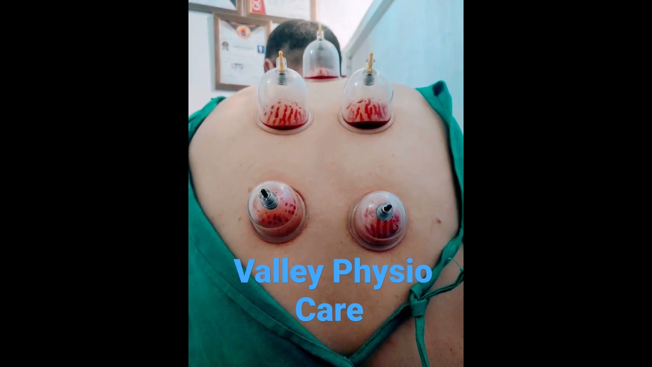 Wet Cupping Therapy Youtube