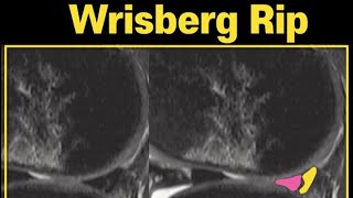 [Shorts #07] Wrisberg Rip_Longitudinal-Vertical Tears #shorts
