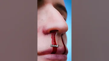 أسباب نزيف الأنف المفاجئ وطرق التعامل معه Shortvideo 