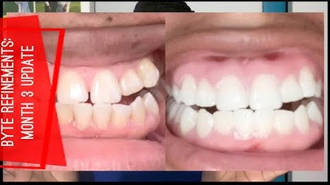 Byte Aligners: MONTH 3 UPDATE! Are these REALLY my teeth?! | Ben and Cin