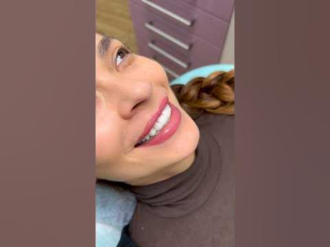 Композитные виниры с прозрачным режущим краем. Без обточки. Dr ...