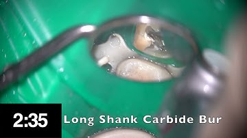 Casting post removal