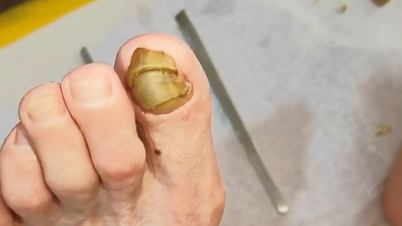 Multiple layers of hard fungal toenail Professional pedicure YouTube