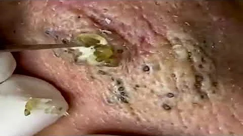 sever acne infection on cheek and old blackheads.
