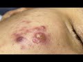 Satisfying with loan nguyen spa 064 acnetreatment