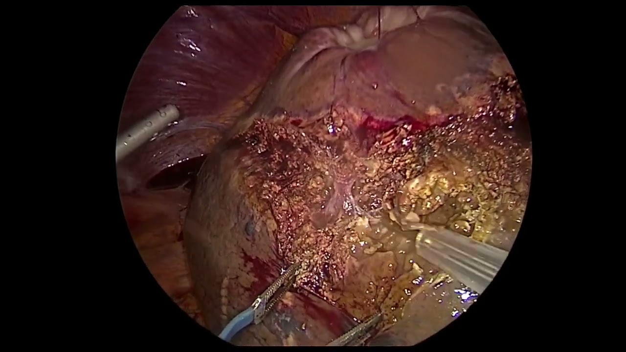 Pure Laparoscopic Liver Resection - Segment 8 - H8 - veins exposures