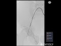 Mentice Iliac and SFA Intervention   Product Video   short version