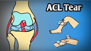 Anterior cruciate ligament tear in hindi & English #acltear #kneepain #sportinjury