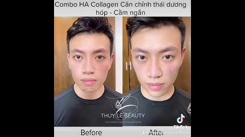 FILLER CHỈNH THÁI DƯƠNG HÓP - CẰM NGẮN - Địa chỉ tiêm filler uy tín số 1 Hà Nội