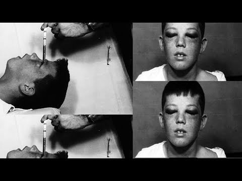 Creepy Before And After Pictures Of People Who Underwent Lobotomies