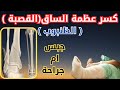 كسر عظمة الساق القصبة في الكبار كسر عظام الساق الظنبوب اهم طرق علاج كسور الساق 