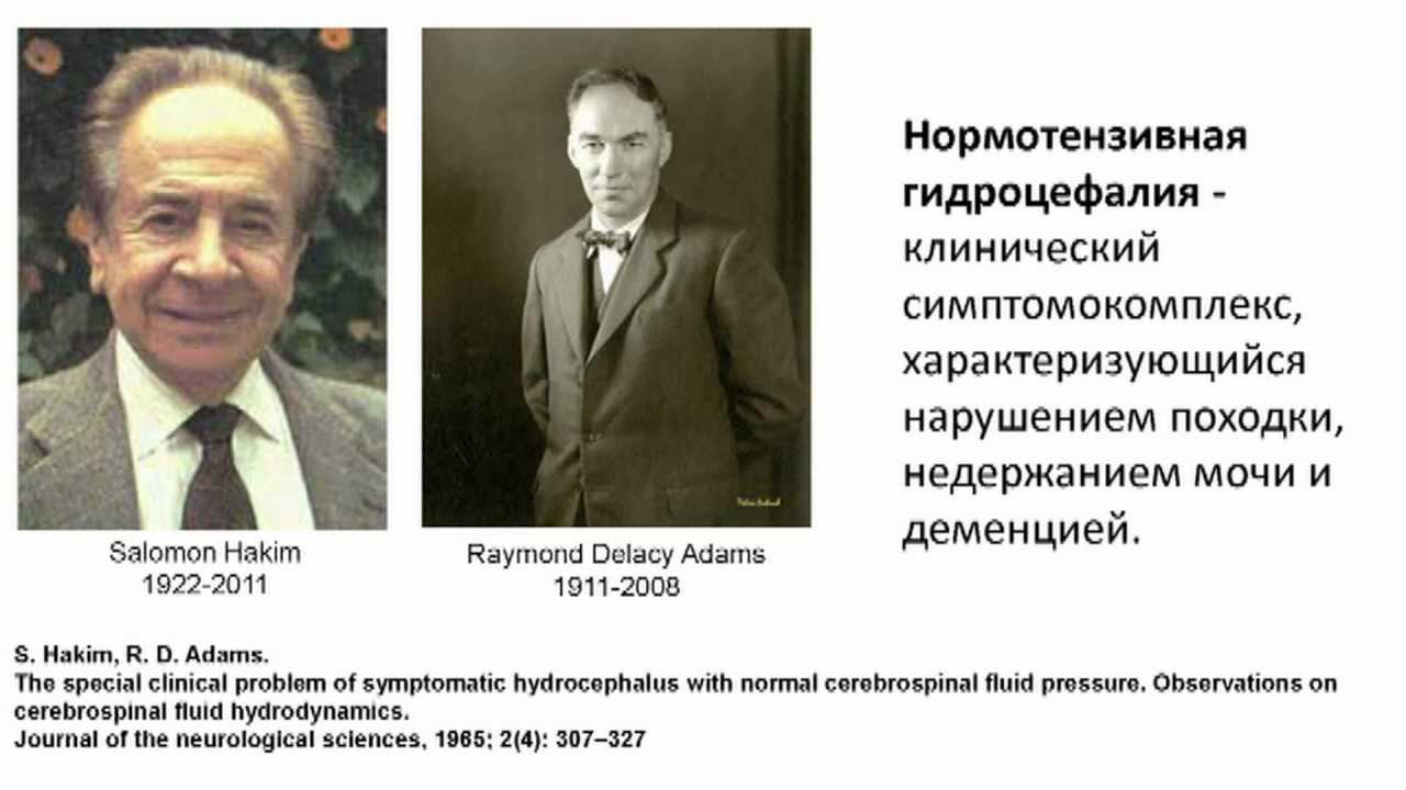 Нормотензивная гидроцефалия