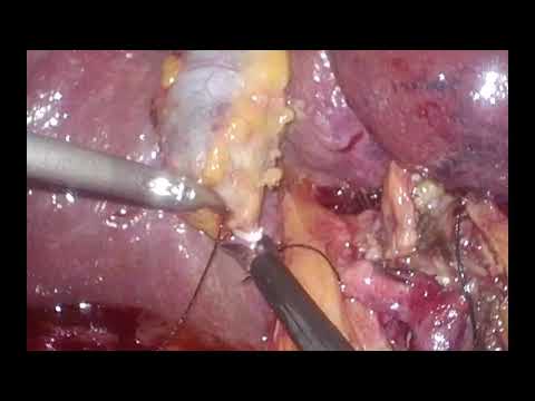 Laparoscopic left hepatectomy extended to segment 1 for huge colorectal metastasis