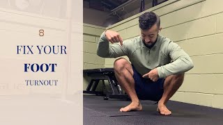 How to Fix Your Foot Turnout (Tibial Torsion or Rotation)