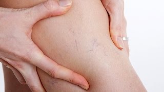 Varices en las piernas y los Factores que las Provocan(http://www.tratamientocontravarices.com/ - Conoce la forma natural con la cual pude combatir las Varices en menos de 60.Dias. http://bit.ly/1w5yhds - No olvides ..., 2015-01-01T20:19:03.000Z)