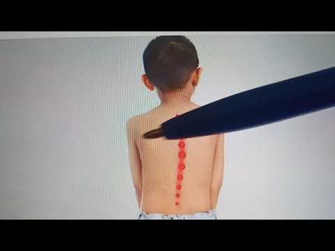 Video: Sukan Apa Yang Baik Untuk Scoliosis Pada Kanak-kanak?