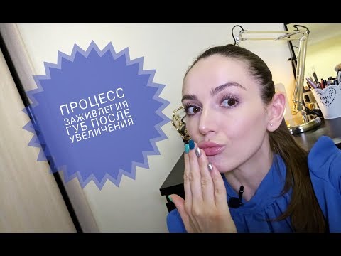 Мой первый опыт увеличения губ, процесс заживления. Dr.Zonova beautyclinic