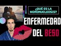 ENFERMEDAD DEL BESO síntomas y signos - MONONUCLEOSIS infecciosa #shorts