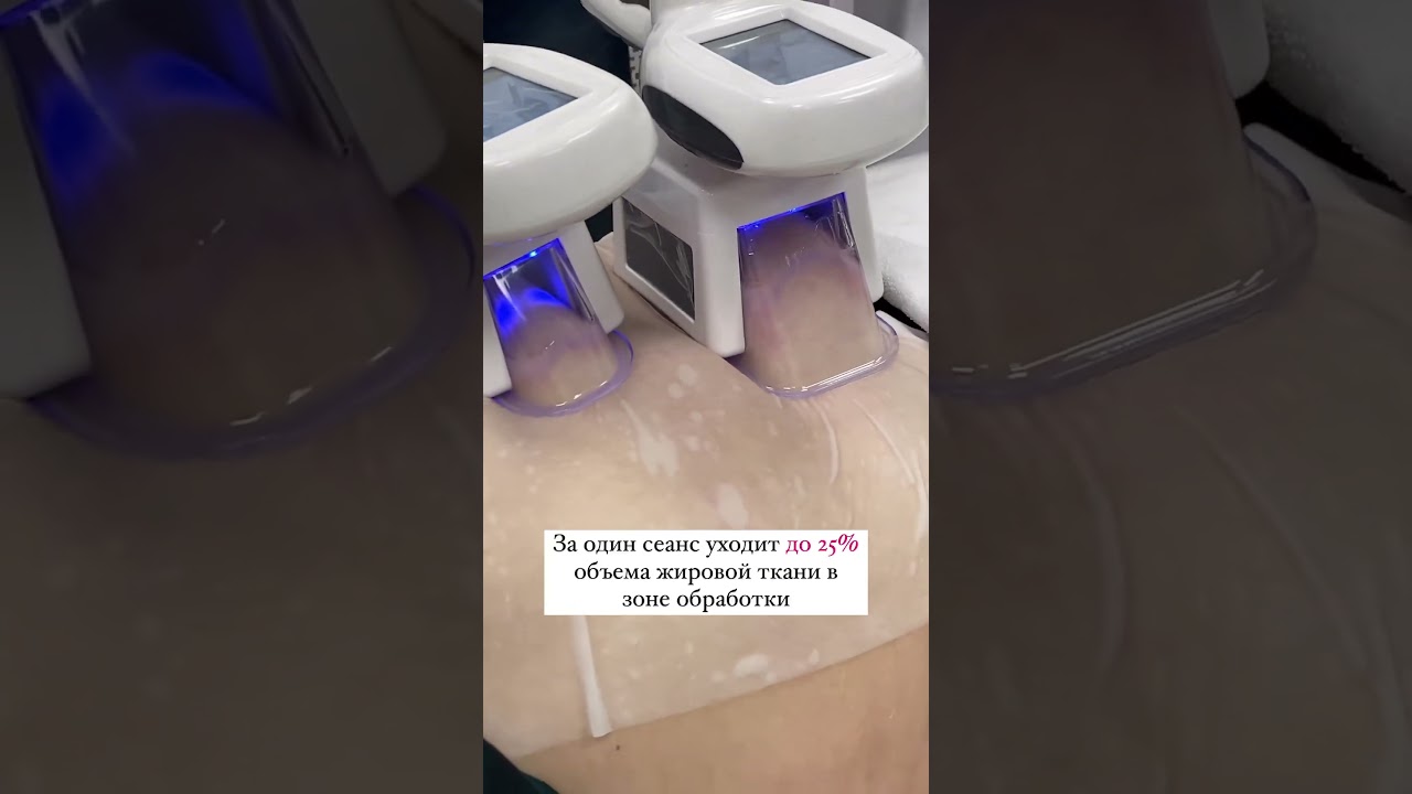 Криолиполиз живота на аппарате S15. В наличии в Эстетик! Заказывайте на сайте estetik-online.ru