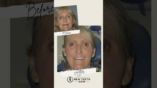 From previous failed dental work to New Teeth Now! #fullmouthdentalimplants #smiletransformation