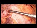 ICG TEST RIGHT COLECTOMY Laparoscopic. Endostapling. Endosuture. 4K. D3