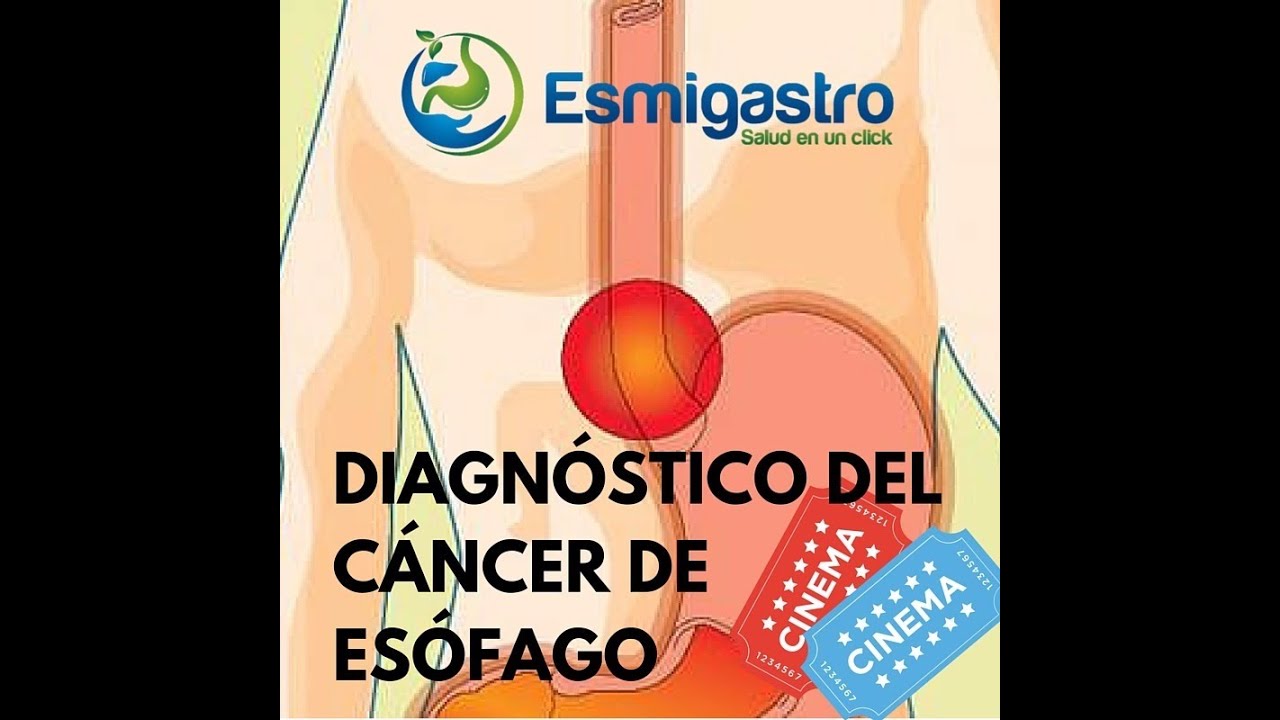 Diagnóstico del Cáncer de Esófago saludos amigos dvd
