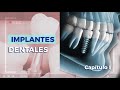 Implantes Dentales parte 1