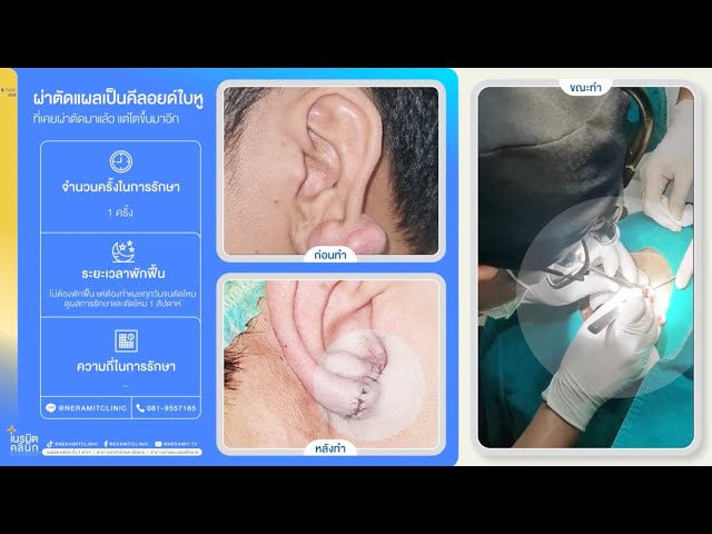ผ่าตัดคีลอยด์ EP.373/หน้าตาแผลคีลอยด์ที่ใบหูของคุณเป็นยังไง @หมอปุ๊ NeramitClinic