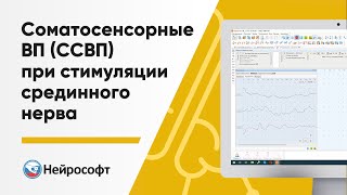 Соматосенсорные вызванные потенциалы (ССВП) при стимуляции срединного нерва