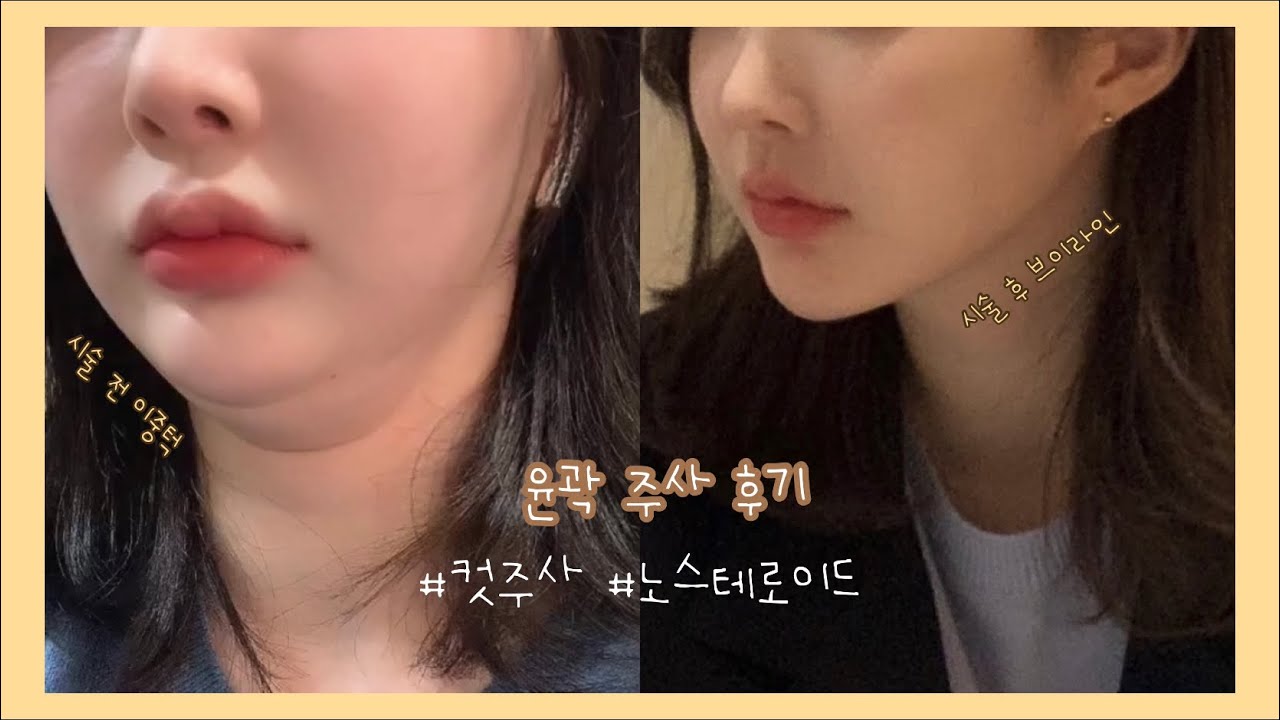 날씬한 얼굴을 위한 강남얼굴윤곽주사 리뷰/합리적인 얼굴지방분해 주사비용!! <갤럼 주사 1회차> 8