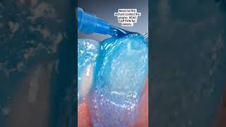 Never use too much etching agent 37% phosphoric acid #dentist #etchingagent #dentalconsumables