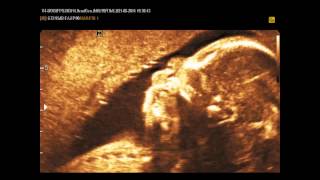 Med2000Eco Bocca E Lingua Fetali