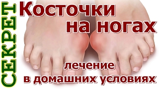 Косточки на ногах лечение видео Косточка на большом пальце ноги – причины дискомфорта