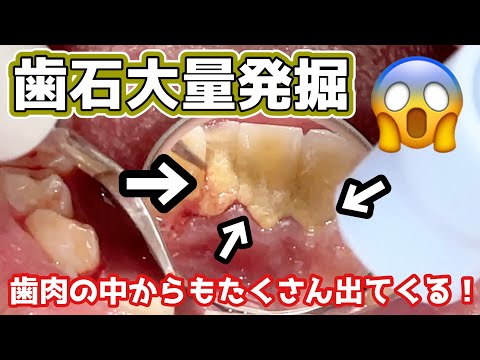 【閲覧注意】はじめての歯石除去でごっそり大量の歯石が...😱 Tartar removal