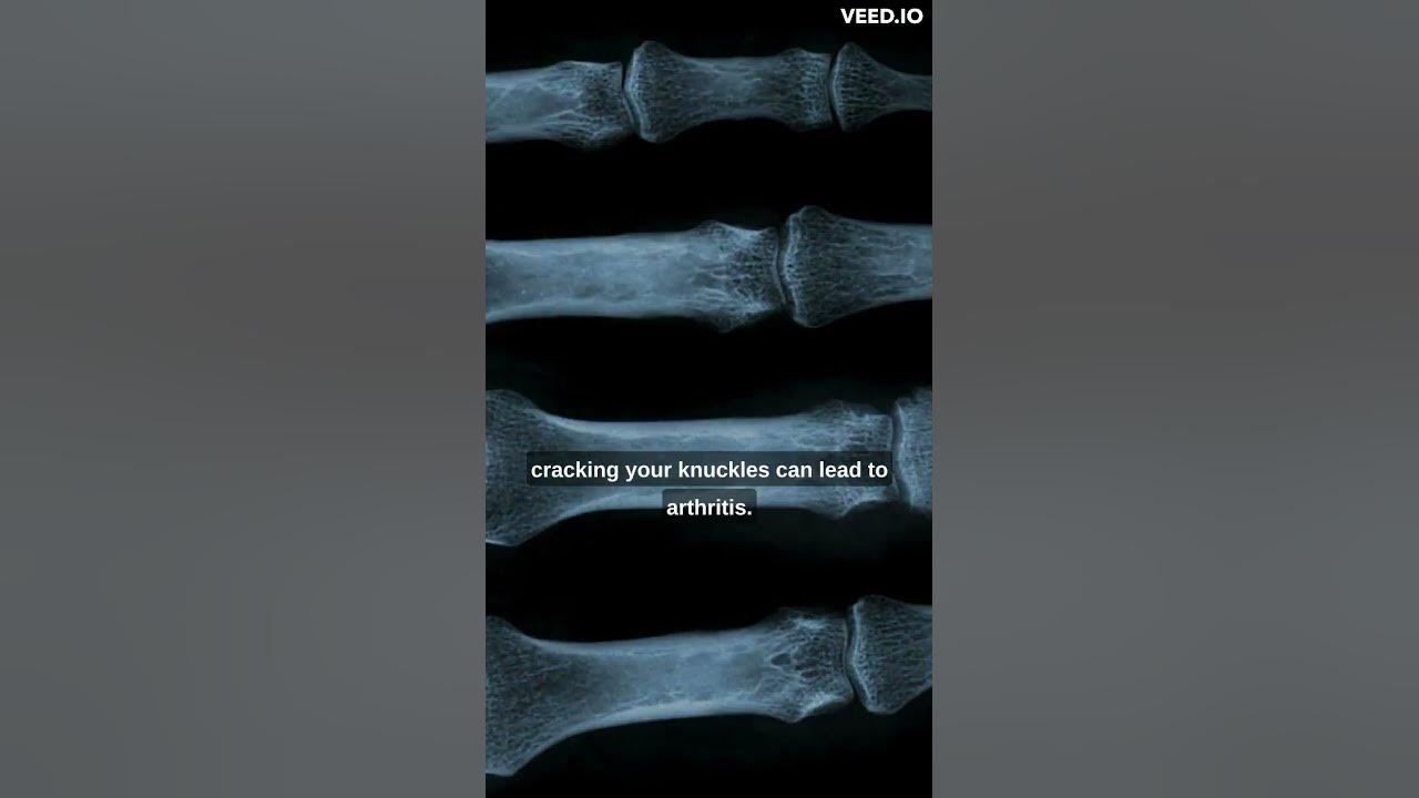 Debunking the Myth Does Cracking Your Knuckles Cause Arthritis? YouTube