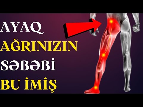 Ayağa Vuran Şiddətli BEL AĞRISININ Səbəbi Bu imiş- Qrijanın Möcüzəvi Müalicəsi!