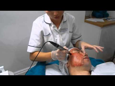 DERMAPEN  Skin Needling For Acne Scarring