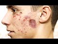 Cystic Acne and Laser Treatment - How to treat cystic acne!
