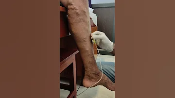 AMH HOSPITAL REHAB CENTER UNANI TREATMENT FOR VARICOSE VEIN FASAD 