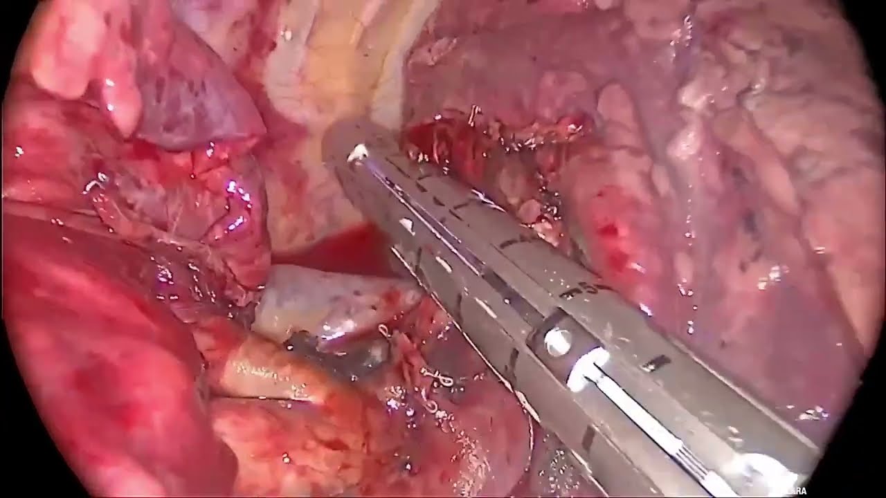 Right S2 segmentectomy