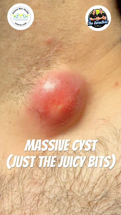 Massive Cyst, Just the Juicy Bits. Incised & Drained by Dr. H.L. Greenberg at Las Vegas Dermatology®
