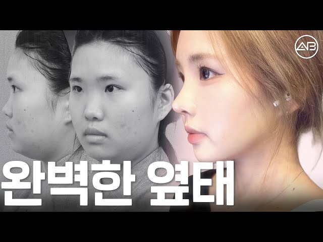 들창코에서 쭉 뻗은 직반라인 코로 | 후기있음 | 에이비성형외과