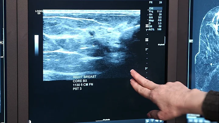 Mayo Clinic Minute: Why breast cancer survivors need mammograms